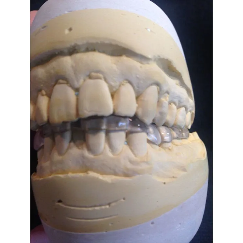 Vsmile 98mm Clear PMMA for partial denture framwork compatible open milling machine system