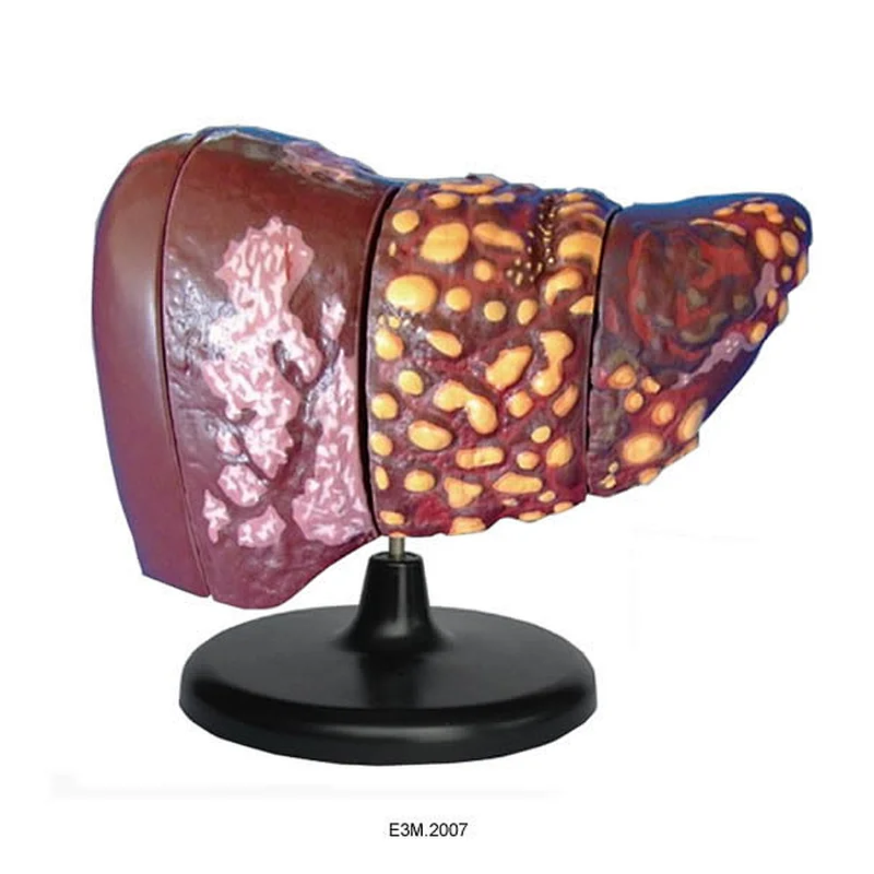 Disease Liver Model