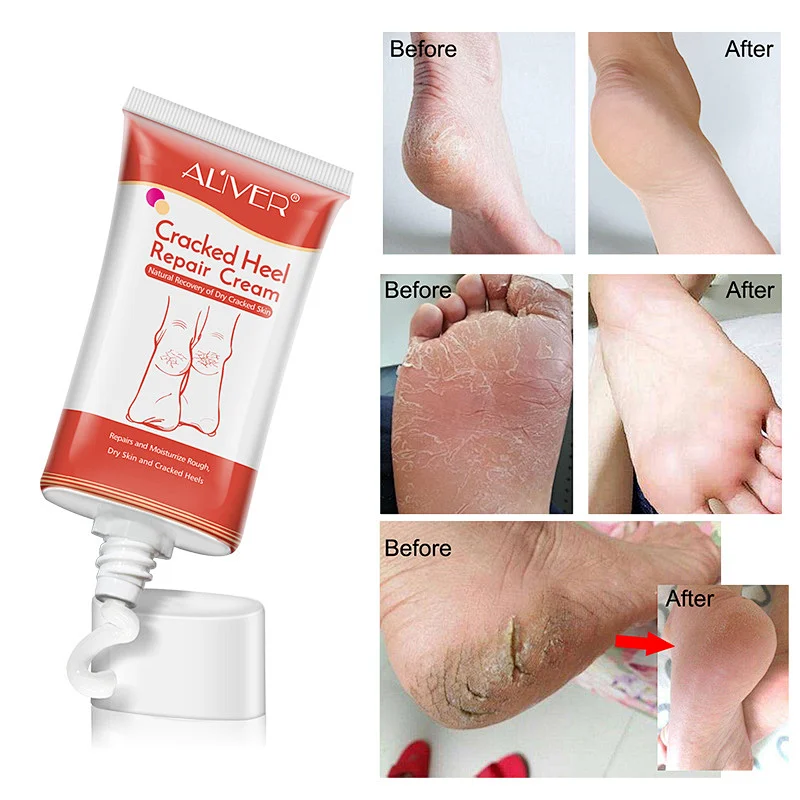Foot care repairs and Moisturrize rough and dry skin cracked heel repair cream