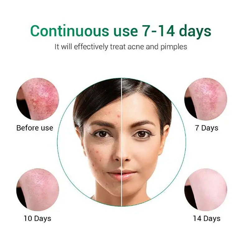 BREYLEE Acne Treatment Cream Anti Acne Face Cream Pimple Removal Spots Oil Control Shrink Pores Cream