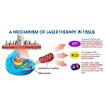 What's LLLT LOW LEVEL LASER THERAPY?