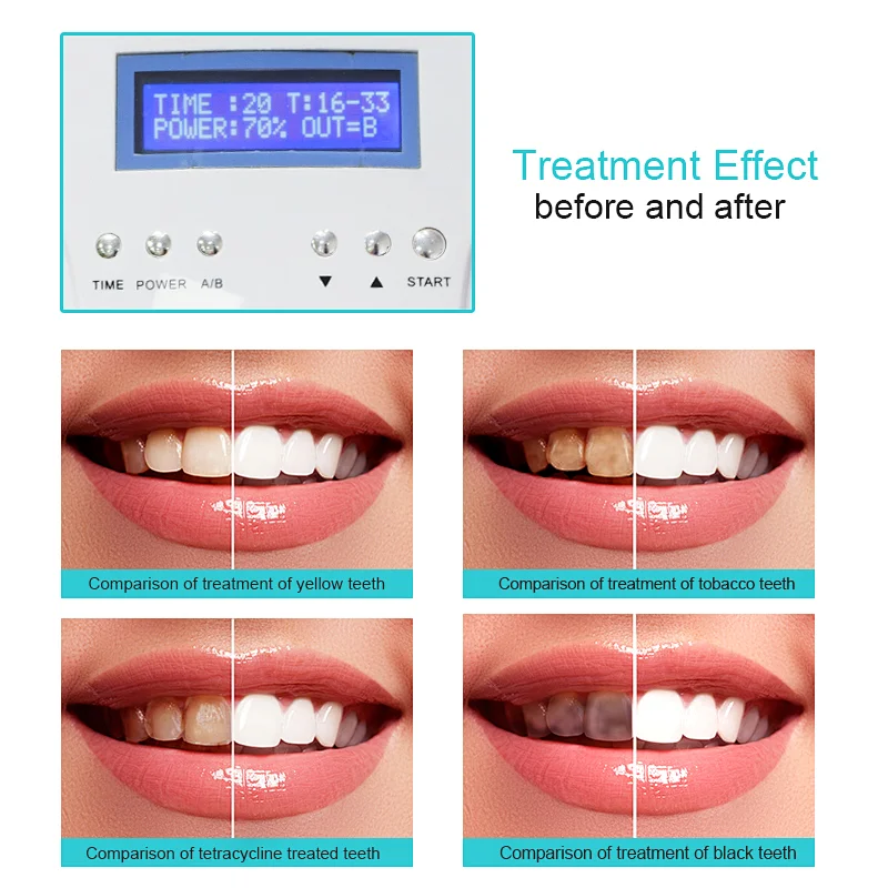 Led Mobile Portable Teeth Whitening