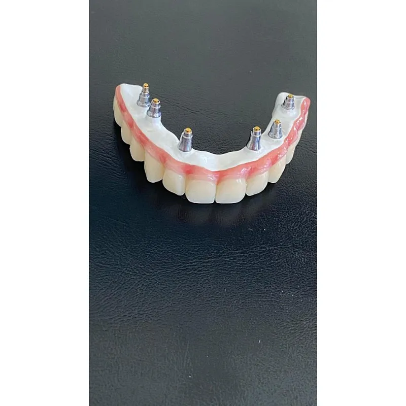 Vsmile CADCAM PEEK Blank for Partial Denture