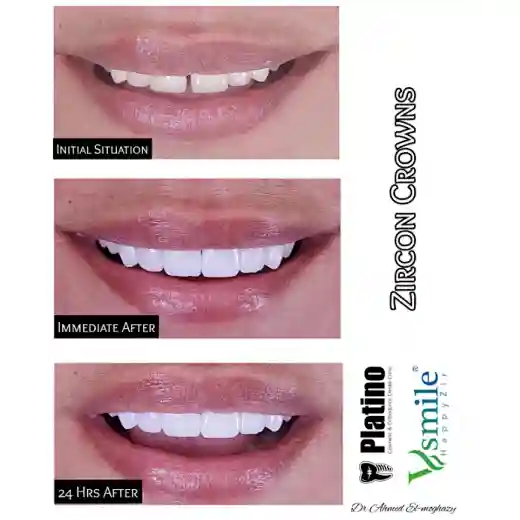 3d zirconia block