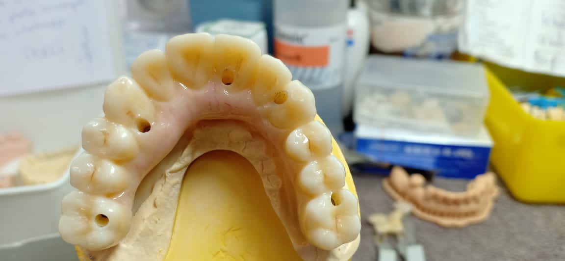 ST colored zirconia