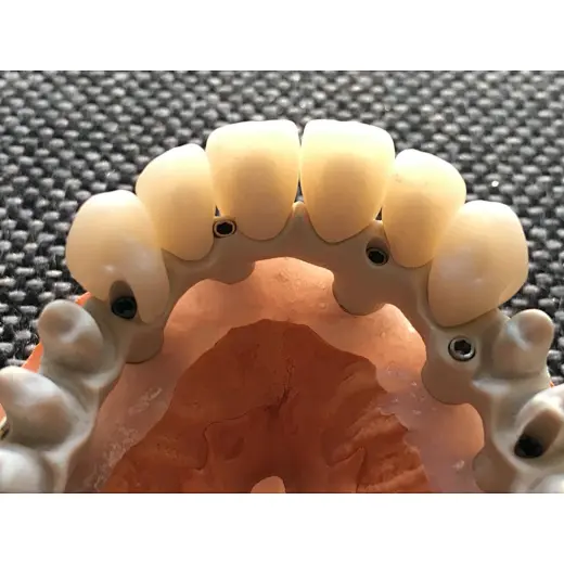 dental casting partial denture