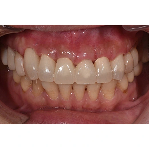 dental zirconia block