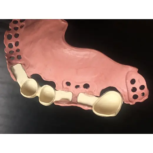 dental casting partial denture