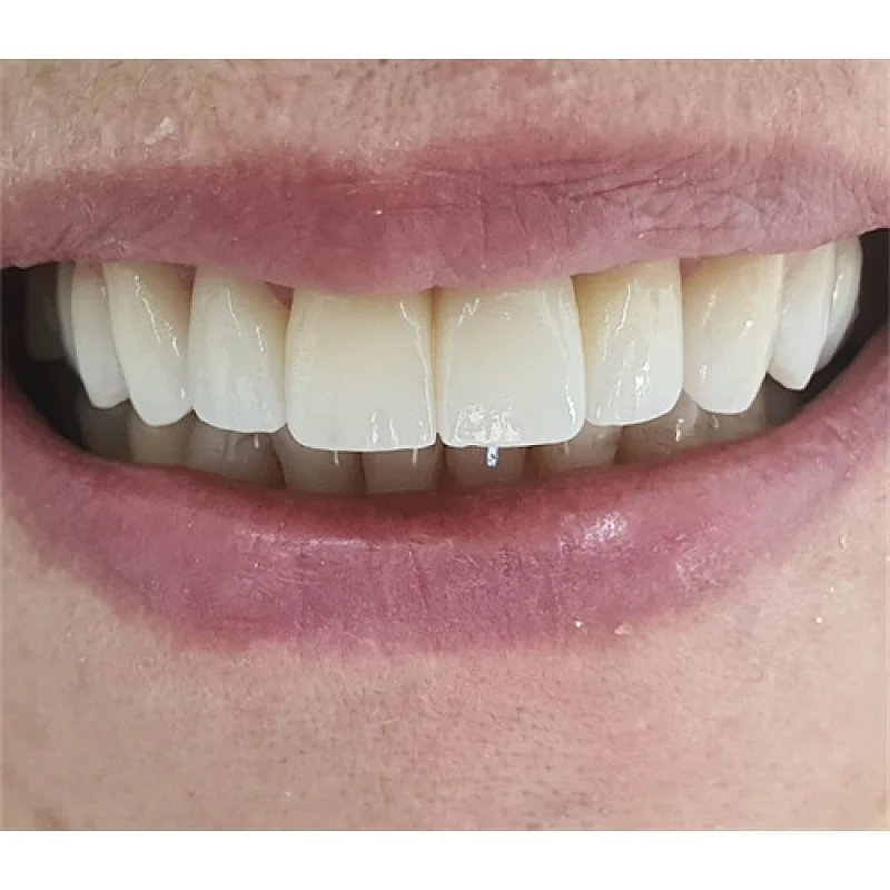 Vsmile 95mm Dental Zirconia Block 3D Pro Multilayer