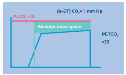 Understanding capnography waveforms