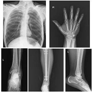 MY-D049R digital portable mobile radiography x- ray system medical x ray machine