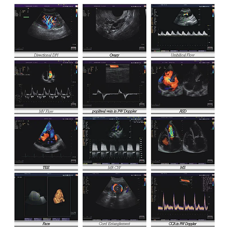 Medical equipment built-in Li-ion battery color doppler ultrasound echocardiography cardiac machine portable