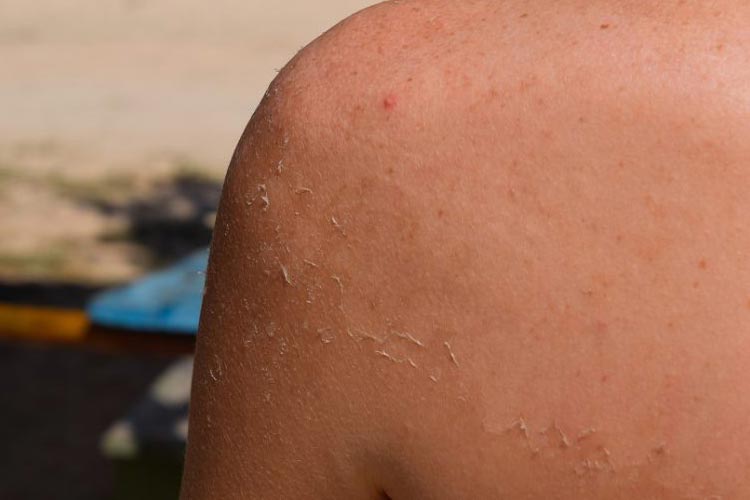 Are saunas bad for sunburn? Explore the questions between them