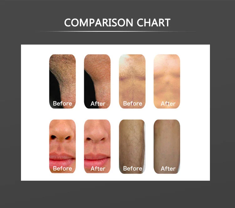 diode laser hair removal machine