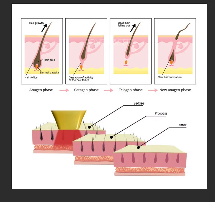 diode laser hair removal machine