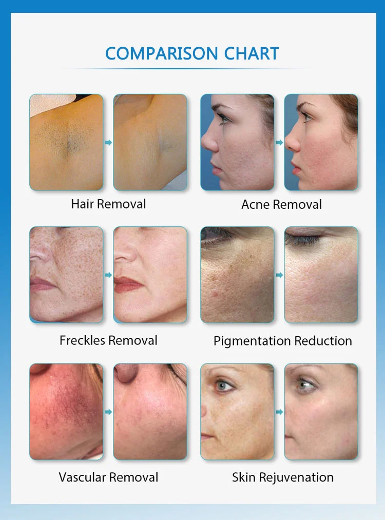 IPL Elight SHR hair removal