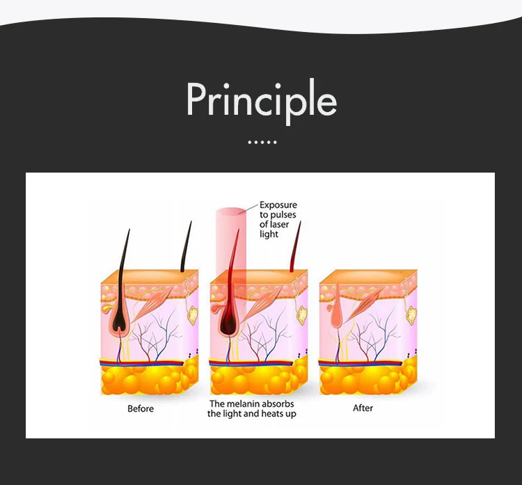 KPL IPL Laser Hair Removal