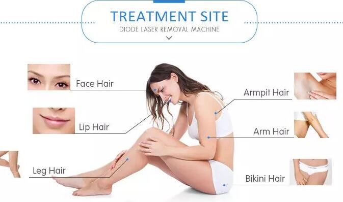 What is Diode Laser Hair Removal