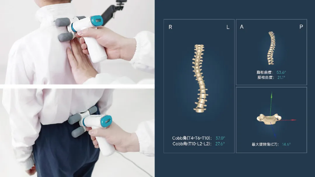 Radiation-Free 3D Spinal Measurement Device